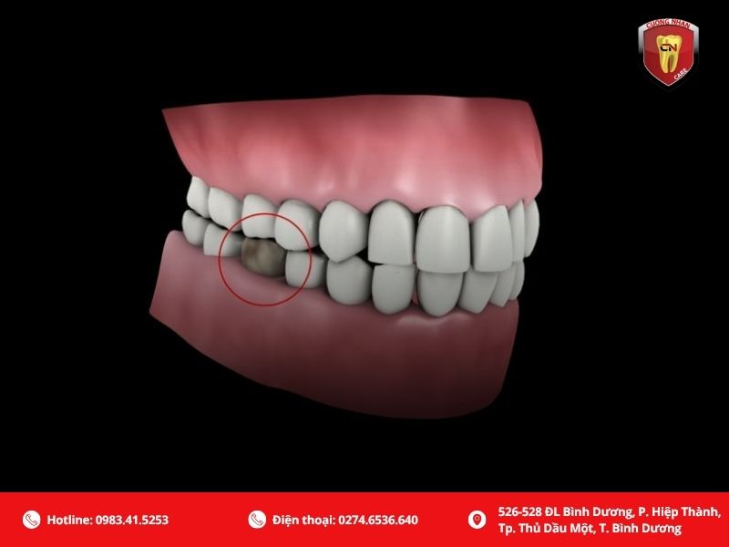 Sâu răng, viêm tủy nặng không thể bảo tồn bắt buộc nhổ răng số 5 hàm dưới