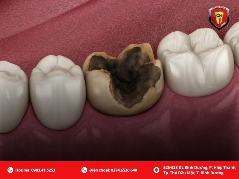 Răng bị vỡ, gãy lớn chỉ còn lại chân răng