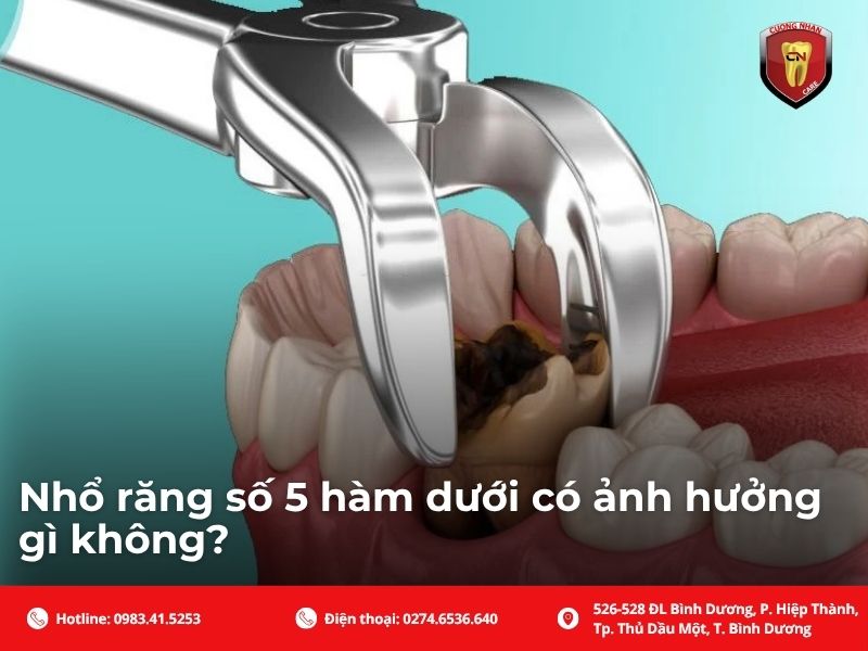 Nhổ răng số 5 hàm dưới có ảnh hưởng gì không