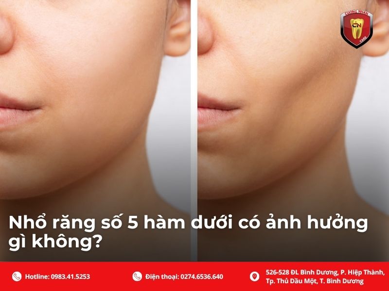 Nhổ răng số 5 gây hóp má
