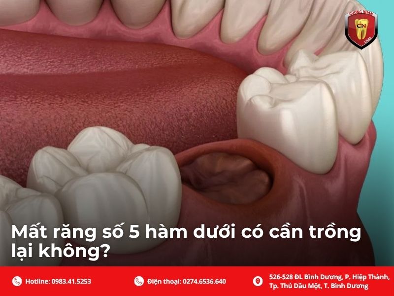 Mất răng số 5 hàm dưới có cần trồng lại không?