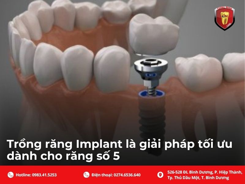 Trồng răng Implant: Giải pháp tối ưu, ngăn chặn tiêu xương hàm