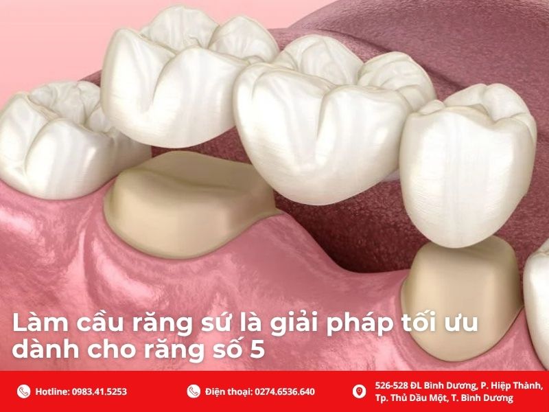 Làm cầu răng sứ: Phục hồi chức năng ăn nhai và thẩm mỹ