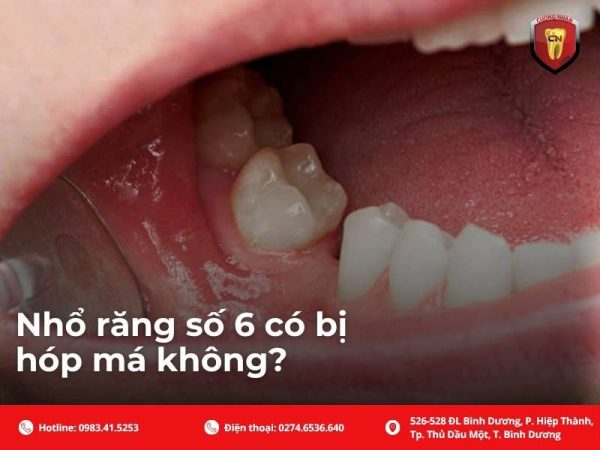 Nhổ răng số 6 có bị hóp má không?
