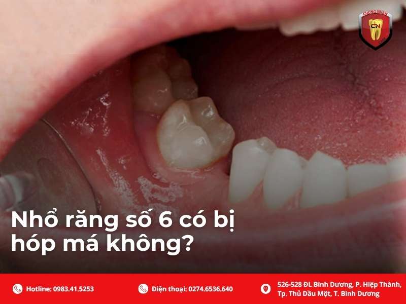 Nhổ răng số 6 có bị hóp má không?