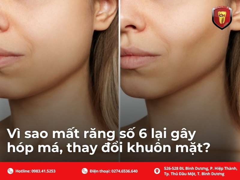 Vì sao mất răng số 6 lại gây hóp má, thay đổi khuôn mặt?