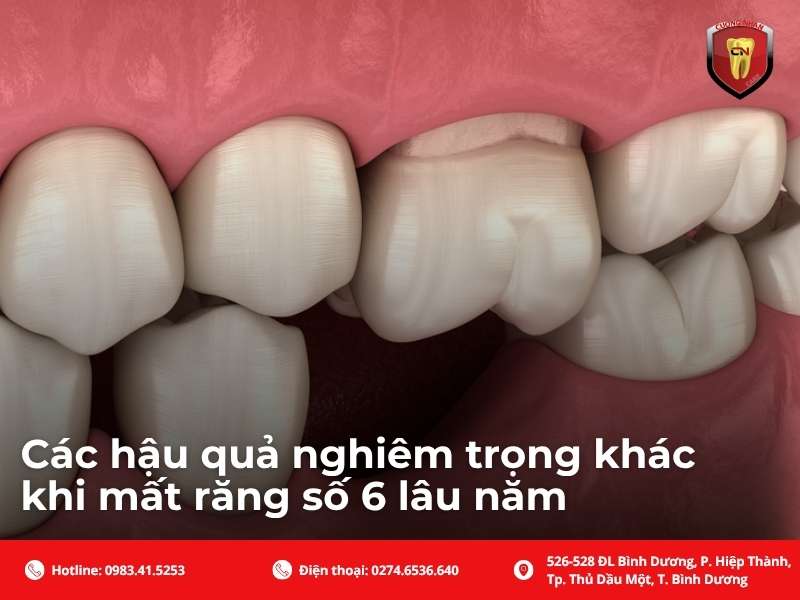 Các hậu quả nghiêm trọng khác khi mất răng số 6 lâu năm