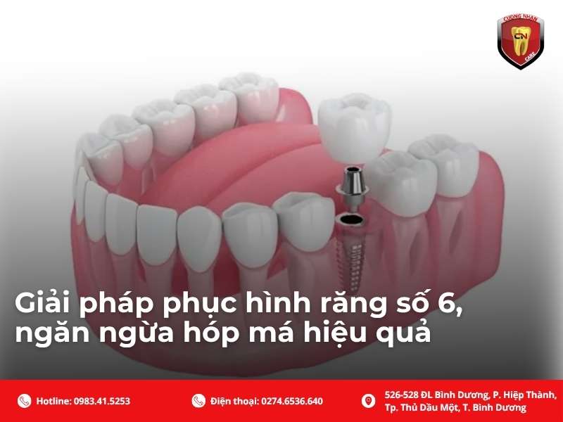 Giải pháp phục hình răng số 6, ngăn ngừa hóp má hiệu quả