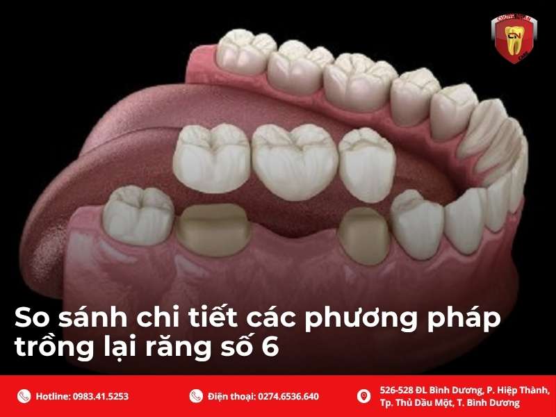 So sánh chi tiết các phương pháp trồng lại răng số 6