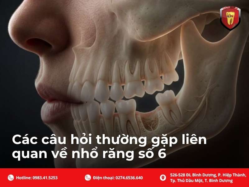 Các câu hỏi thường gặp liên quan về nhổ răng số 6