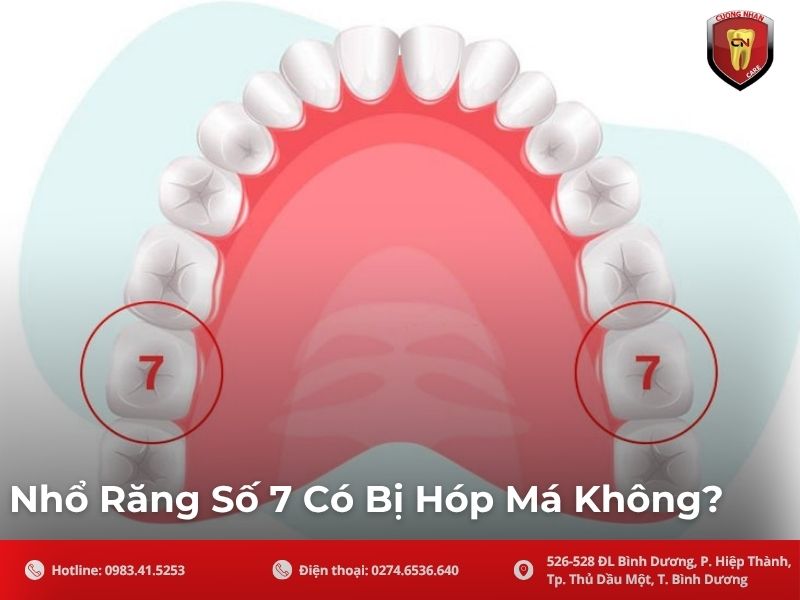 Nhổ một răng số 7 đơn lẻ KHÔNG gây hóp má