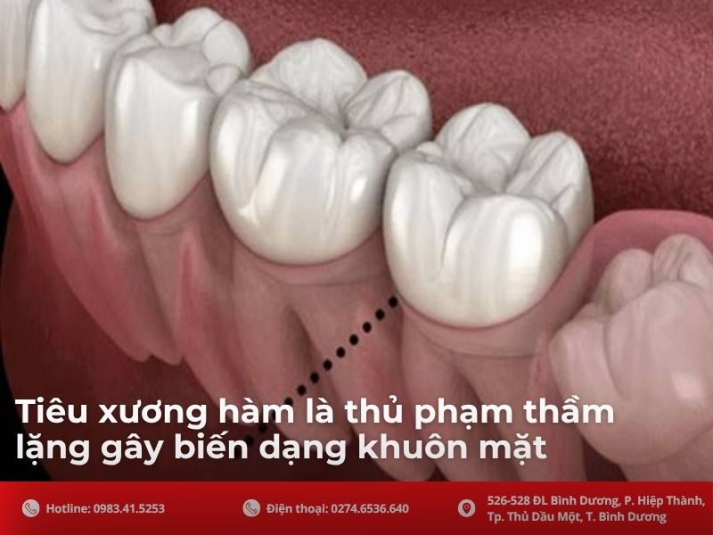 Tiêu xương hàm - “Thủ phạm” thầm lặng gây biến dạng khuôn mặt