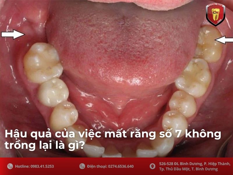 Hậu quả của việc mất răng số 7 không trồng lại là gì?