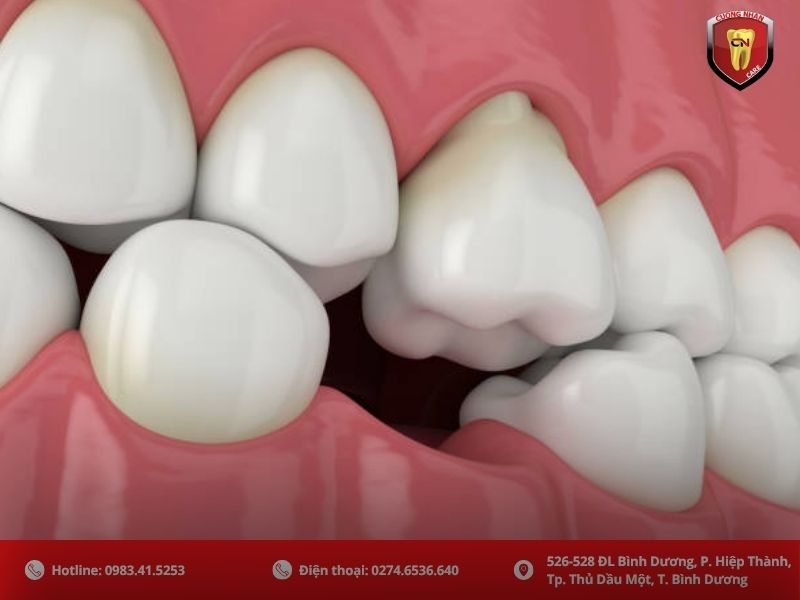 Răng đối diện trồi dài xuống, gây khó khăn khi ăn nhai