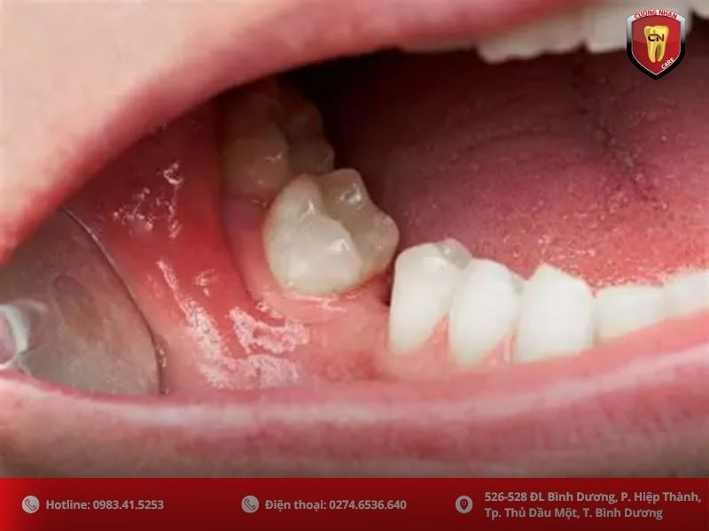 Nhổ răng số 7 có nguy hiểm không? Quy trình loại bỏ răng số 7 chuẩn y khoa
