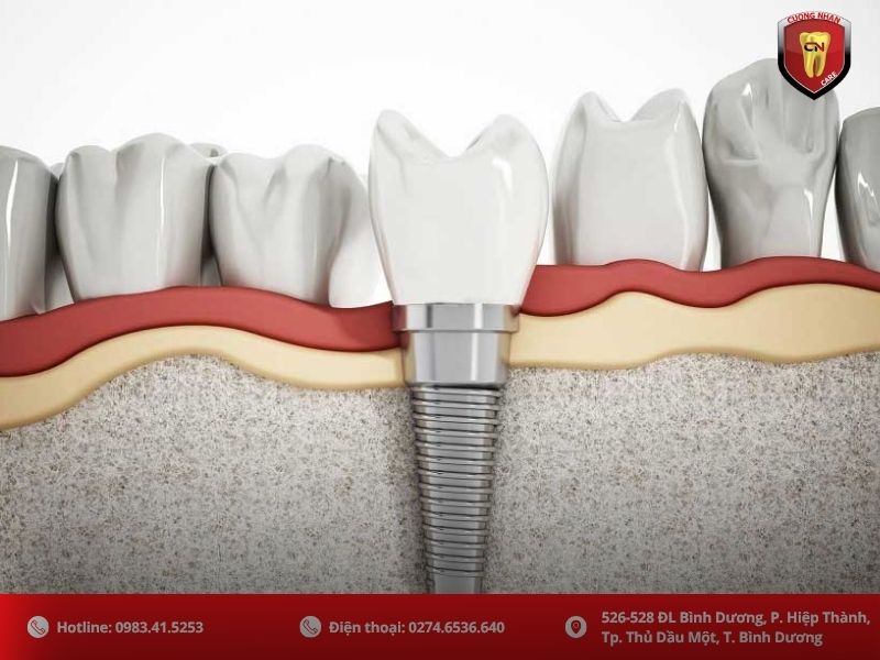 Trồng răng Implant: Giải pháp tối ưu ngăn chặn tiêu xương, khôi phục toàn diện
