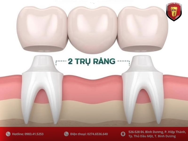 Làm cầu răng sứ: Lựa chọn thay thế tiết kiệm chi phí hơn