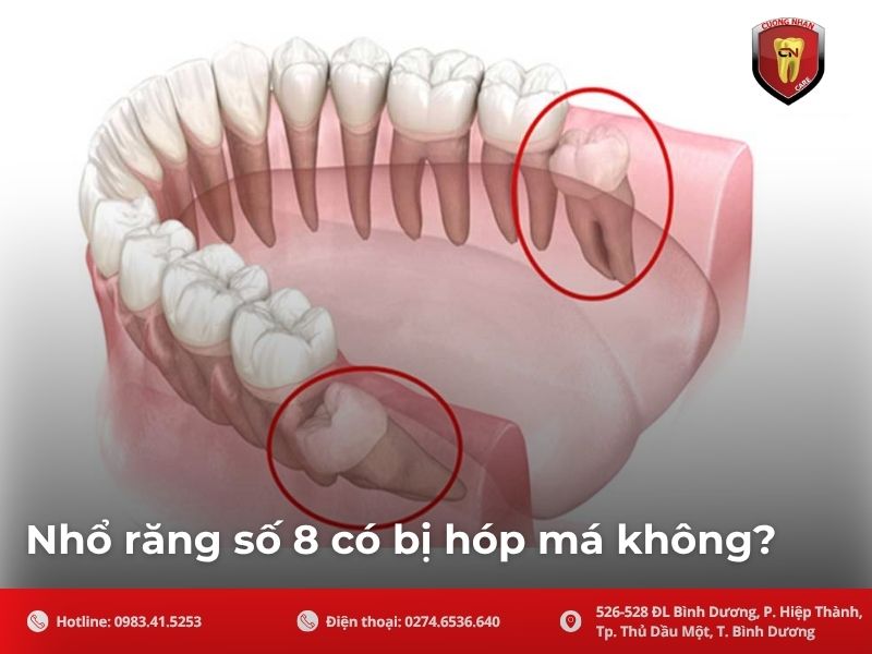 Cùng tìm hiểu vì sao răng số 8 không ảnh hưởng đến cơ má?