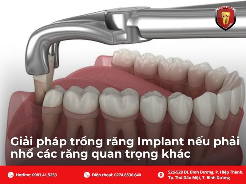 Giải pháp trồng răng Implant nếu phải nhổ các răng quan trọng khác
