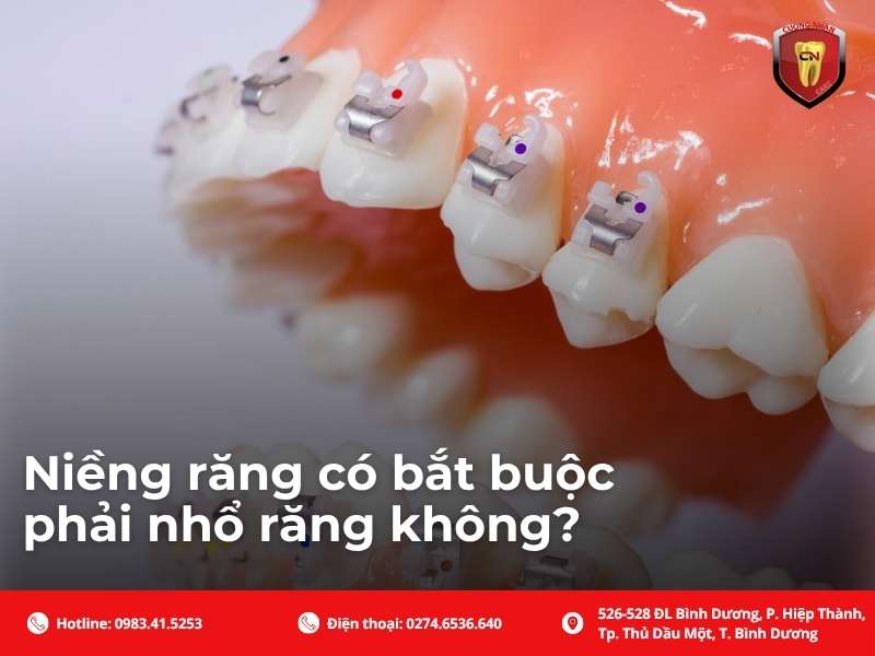 Niềng răng có bắt buộc phải nhổ răng không?