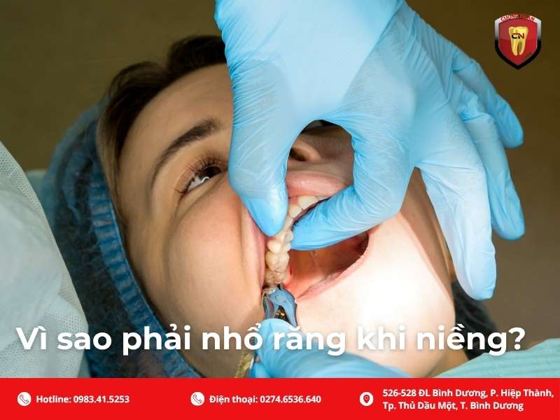 Vì sao phải nhổ răng khi niềng? Mục đích chính là