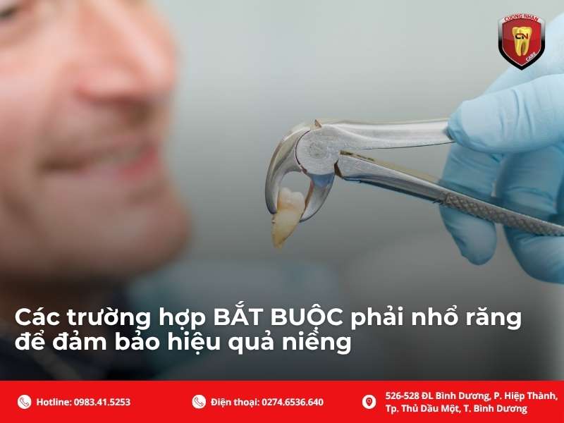 Các trường hợp BẮT BUỘC phải nhổ răng để đảm bảo hiệu quả niềng