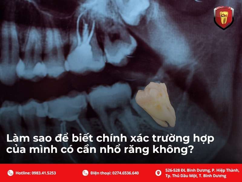 Giải đáp các câu hỏi thường gặp về nhổ răng khi niềng