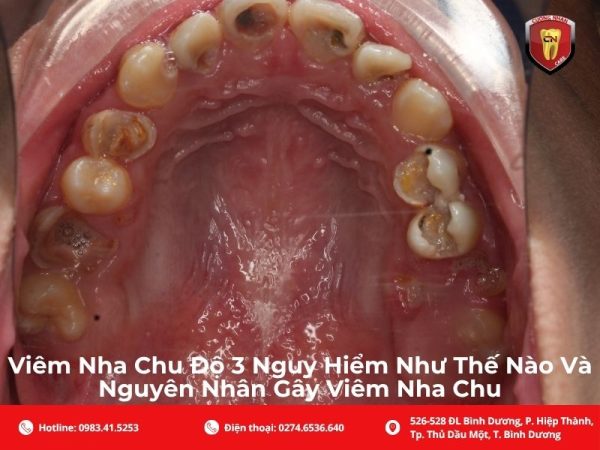 Viêm Nha Chu Độ 3 Nguy Hiểm Như Thế Nào Và Nguyên Nhân Gây Viêm Nha Chu
