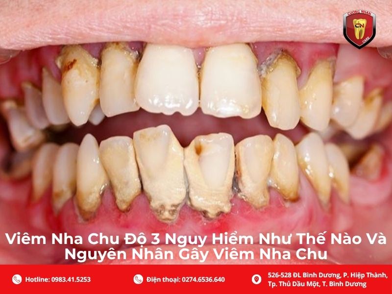 Viêm nha chu độ 3 là gì? Vì sao được xem là giai đoạn báo động?