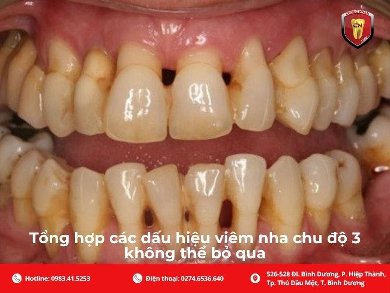 Tổng hợp các dấu hiệu viêm nha chu độ 3 không thể bỏ qua