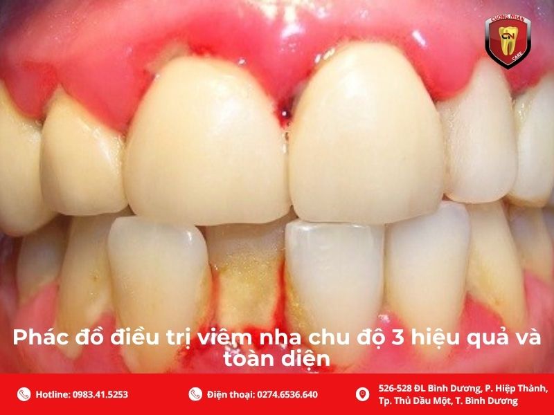 Phác đồ điều trị viêm nha chu độ 3 hiệu quả và toàn diện