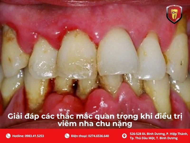 Giải đáp các thắc mắc quan trọng khi điều trị viêm nha chu nặng