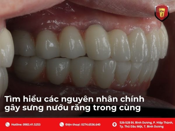 Tìm hiểu các nguyên nhân chính gây sưng nướu răng trong cùng