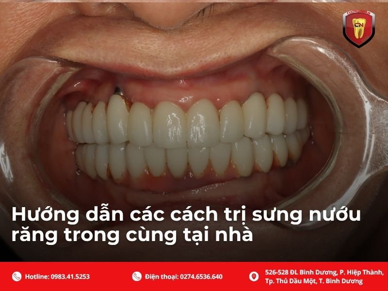 Hướng dẫn các cách trị sưng nướu răng trong cùng tại nhà