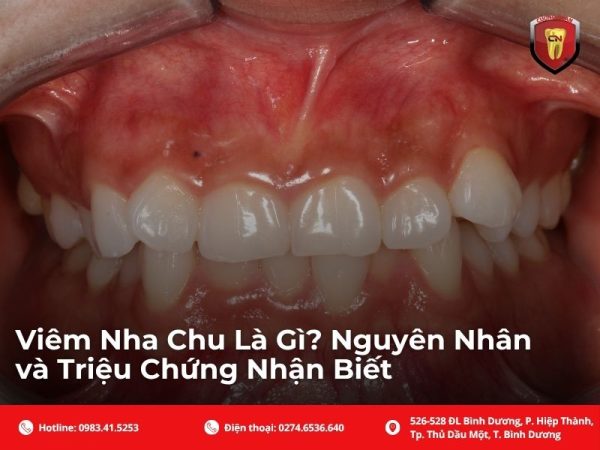 Viêm nha chu là gì? Nguyên nhân và triệu chứng nhận biết