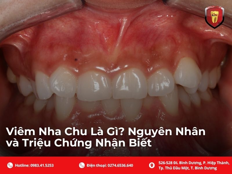 Viêm nha chu là gì? Nguyên nhân và triệu chứng nhận biết