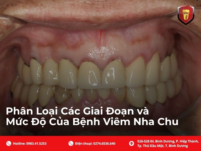 Phân loại các giai đoạn và mức độ của bệnh viêm nha chu