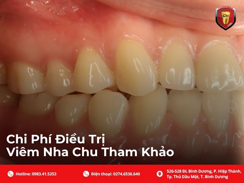 Chi Phí Điều Trị Viêm Nha Chu Tham Khảo