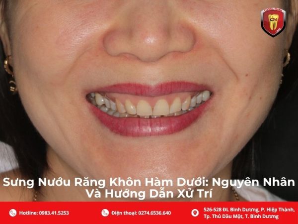 Nguyên nhân phổ biến gây sưng nướu răng khôn hàm dưới