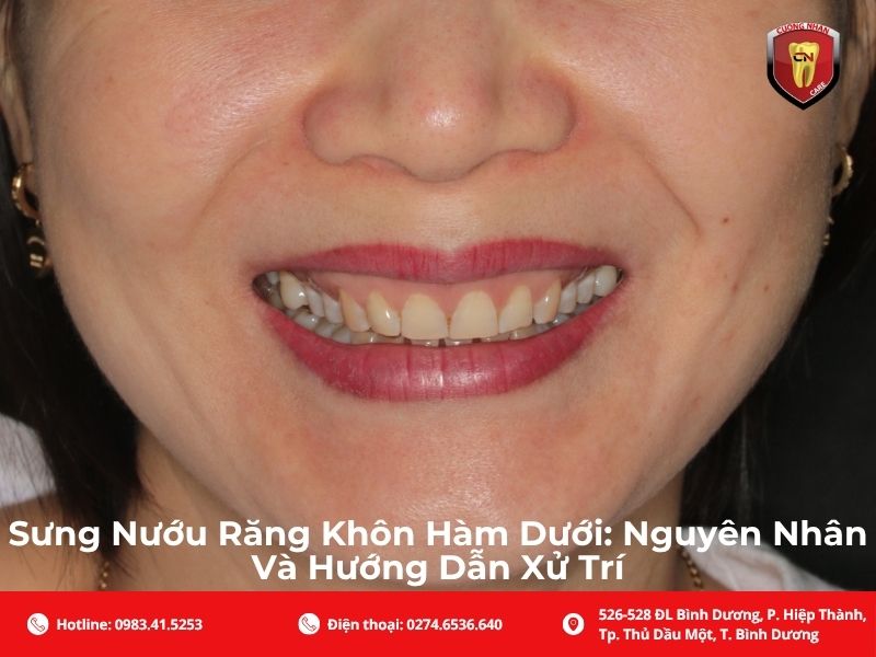 Nguyên nhân phổ biến gây sưng nướu răng khôn hàm dưới