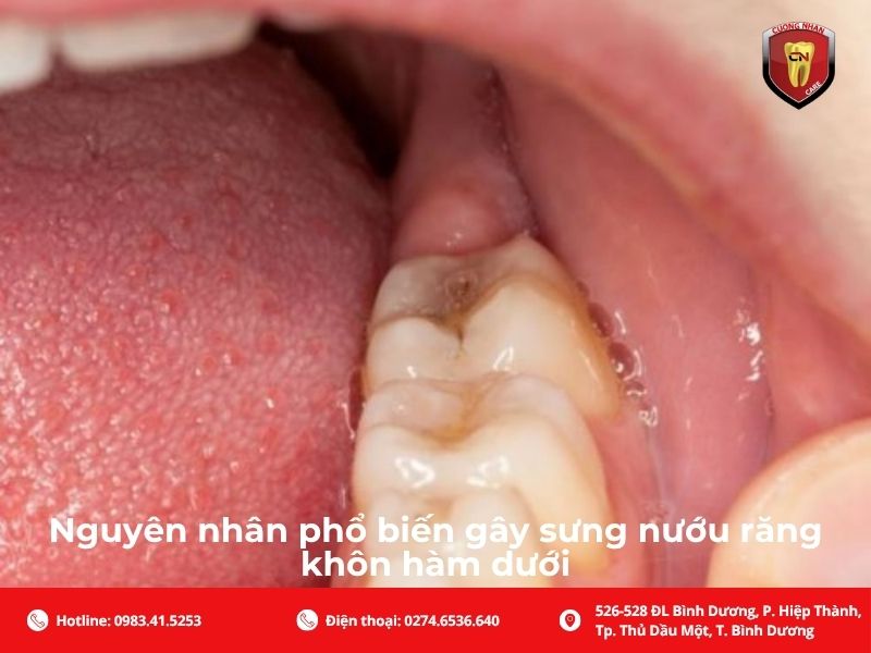 Nguyên nhân phổ biến gây sưng nướu răng khôn hàm dưới