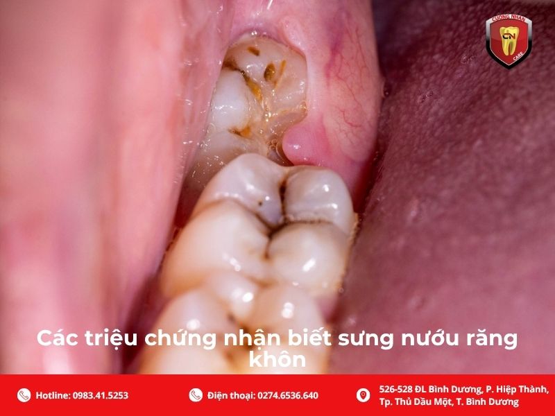 Các triệu chứng nhận biết sưng nướu răng khôn