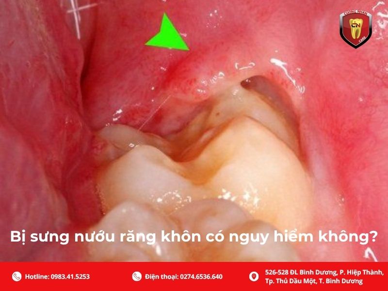 Bị sưng nướu răng khôn có nguy hiểm không?