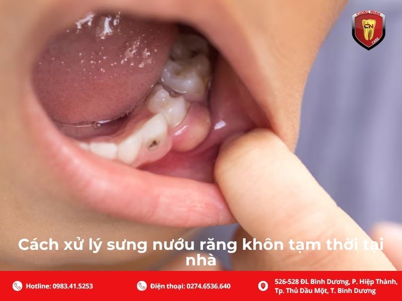 Cách xử lý sưng nướu răng khôn tạm thời tại nhà