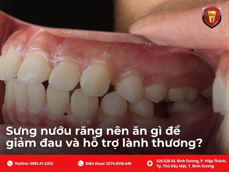 Sưng nướu răng nên ăn gì để giảm đau và hỗ trợ lành thương?