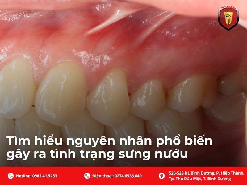 Bị sưng nướu răng kiêng ăn gì để tránh tình trạng tệ hơn?