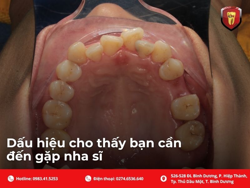 Tìm hiểu nguyên nhân phổ biến gây ra tình trạng sưng nướu