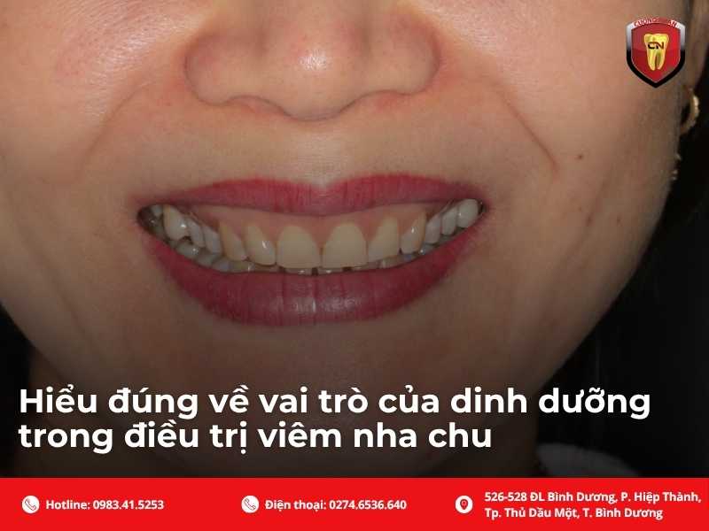 Hiểu đúng về vai trò của dinh dưỡng trong điều trị viêm nha chu