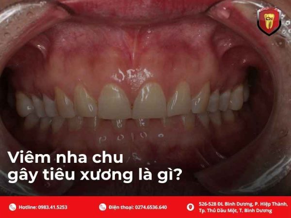 Viêm nha chu gây tiêu xương là gì?
