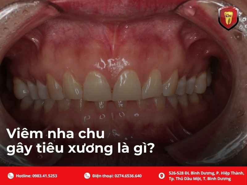 Viêm nha chu gây tiêu xương là gì?